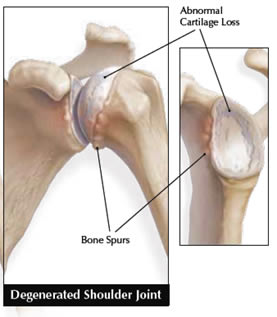 p degenerated shoulder joint