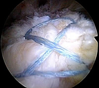 p double row rotator cuff repair