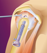 p rotator cuff illustration