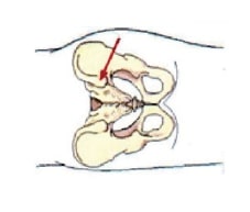 posterior iliac crest